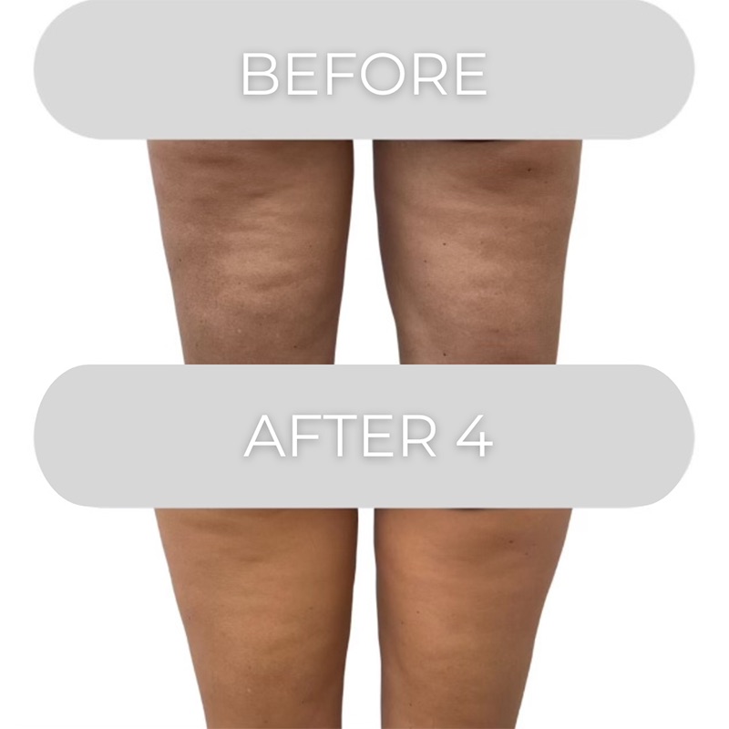 Body Sculpting Before & After Image