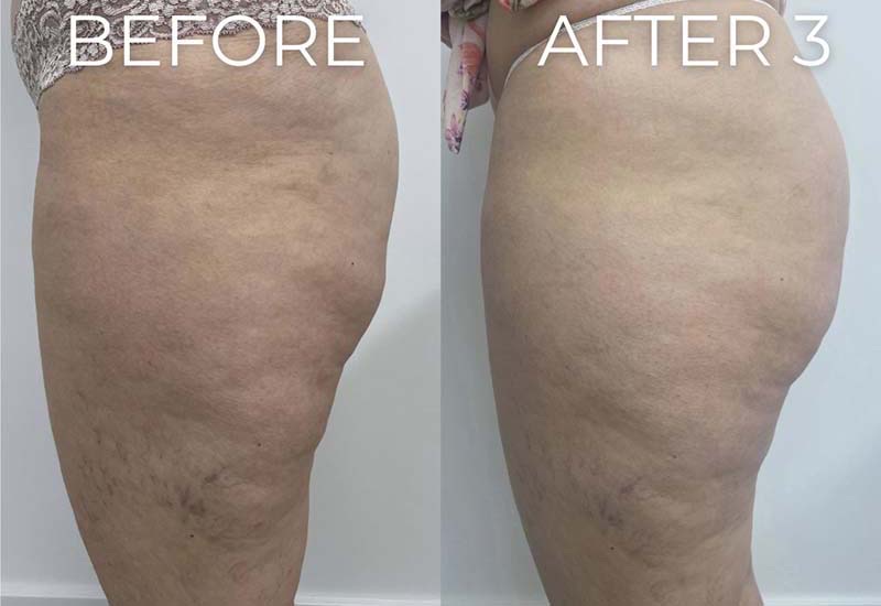 Body Sculpting Before & After Image