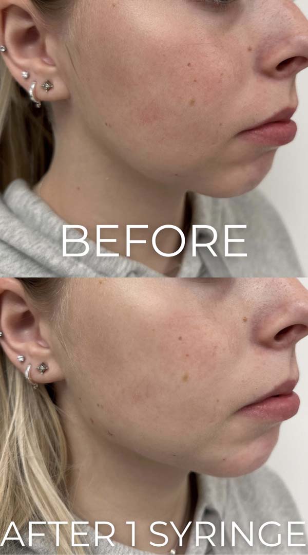 Chin & Jawline Fillers Before & After Image