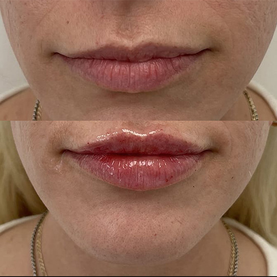 Lip Fillers Before & After Image