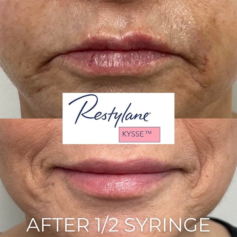 Lip Fillers Before & After Image