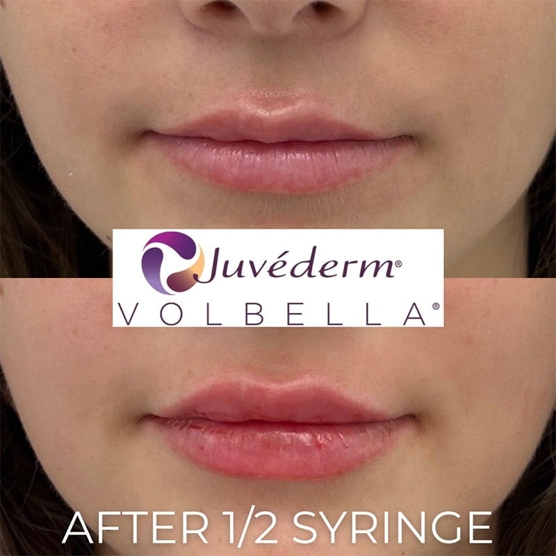 Lip Fillers Before & After Image