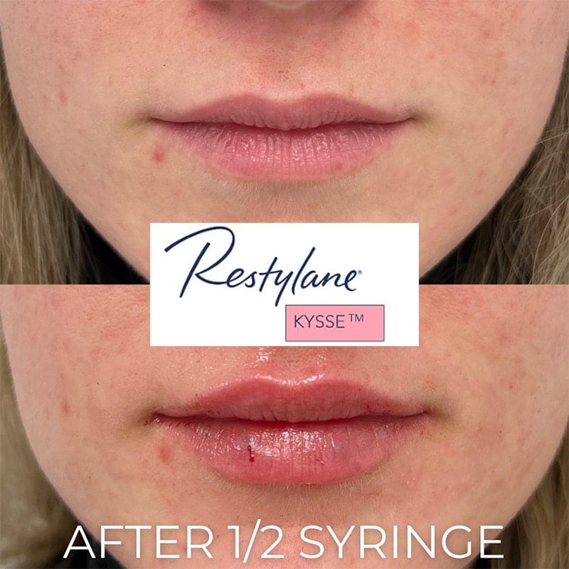 Lip Fillers Before & After Image