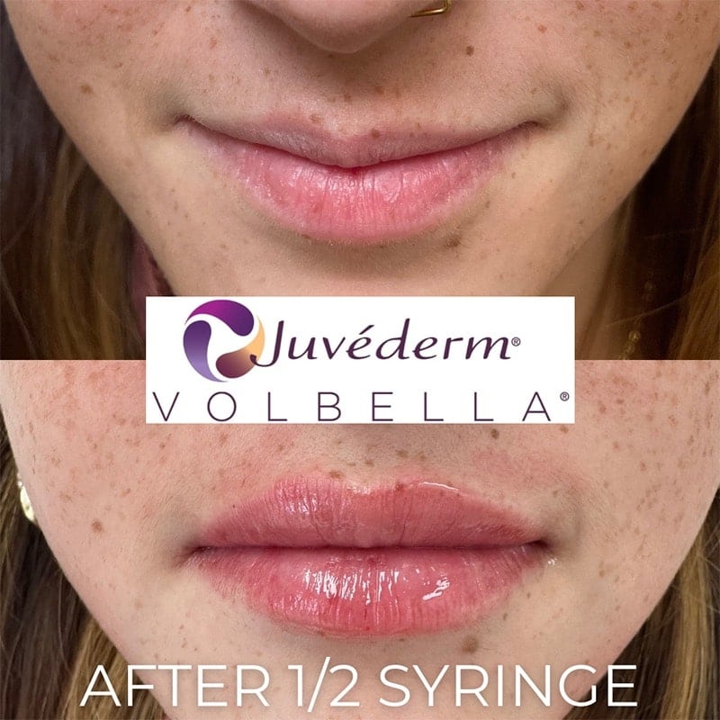 Lip Fillers Before & After Image