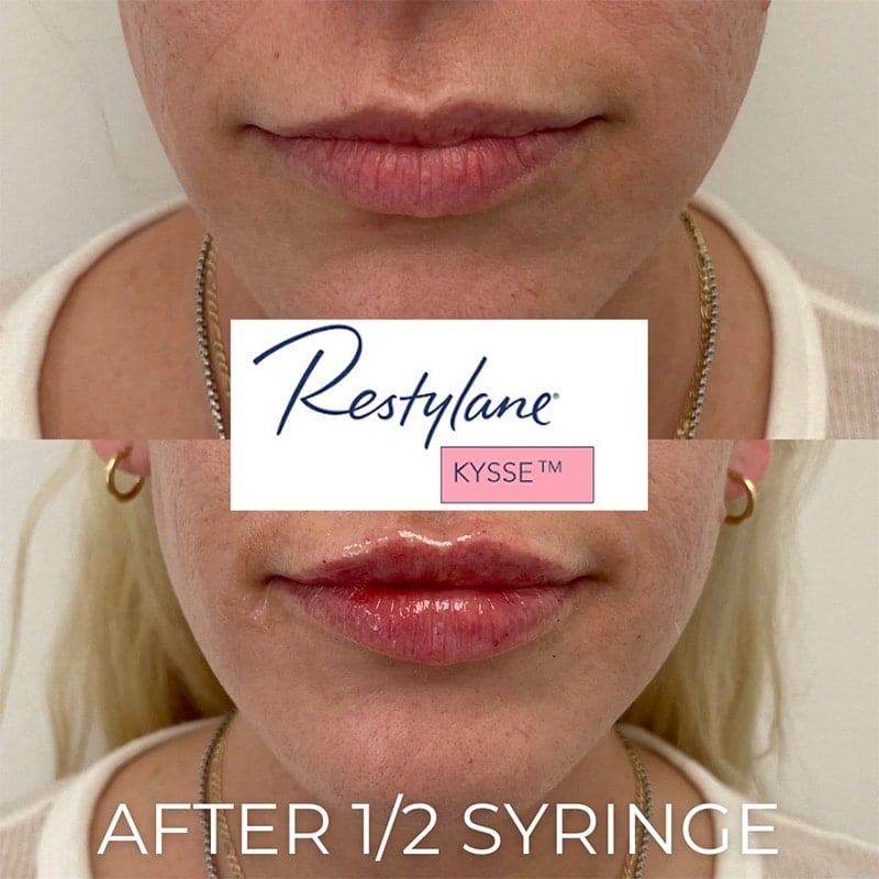 Lip Fillers Before & After Image