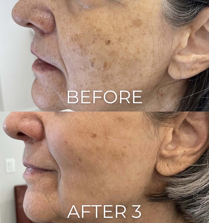 IPL Photofacial Before & After Image