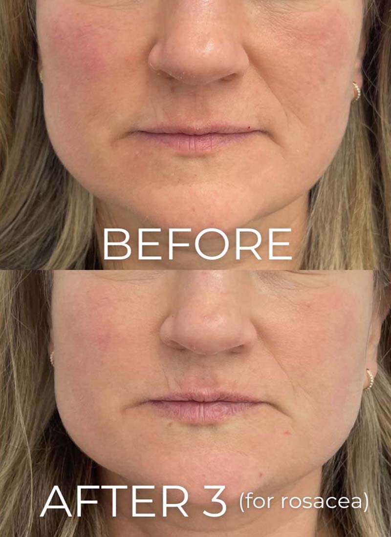 IPL Photofacial Before & After Image