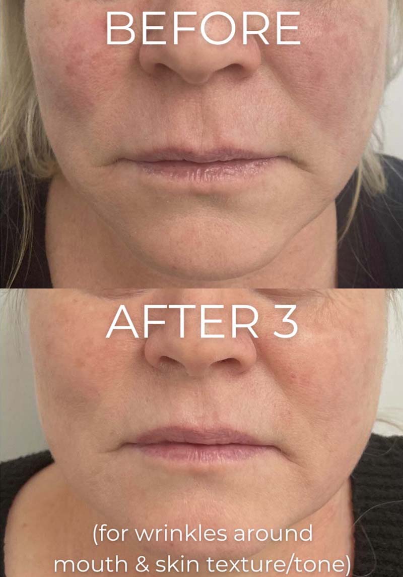 Opus Plasma Before & After Image