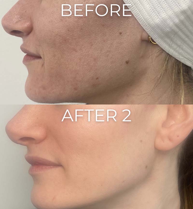 Microneedling Before & After Image