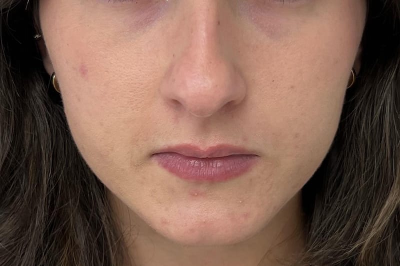 Microneedling Before & After Image